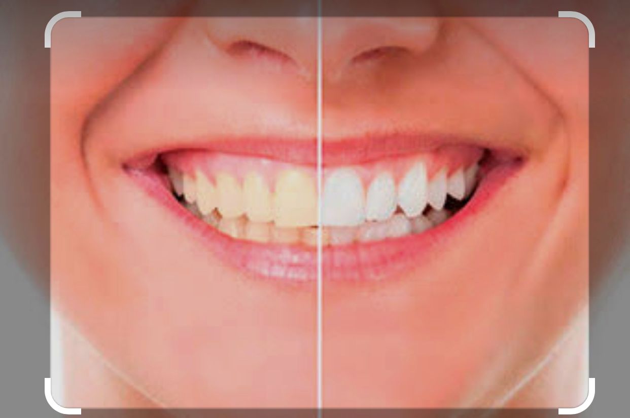 Resultado de clareamento dental: antes e depois