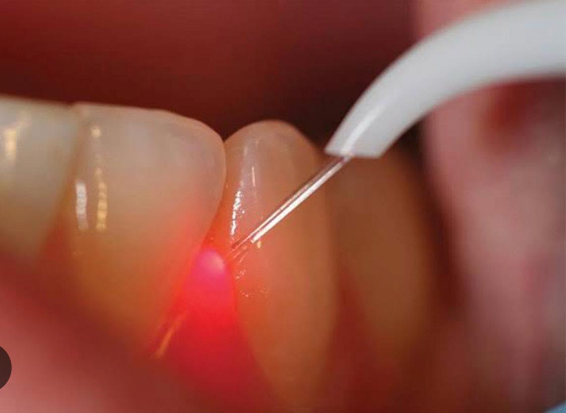 Laserterapia